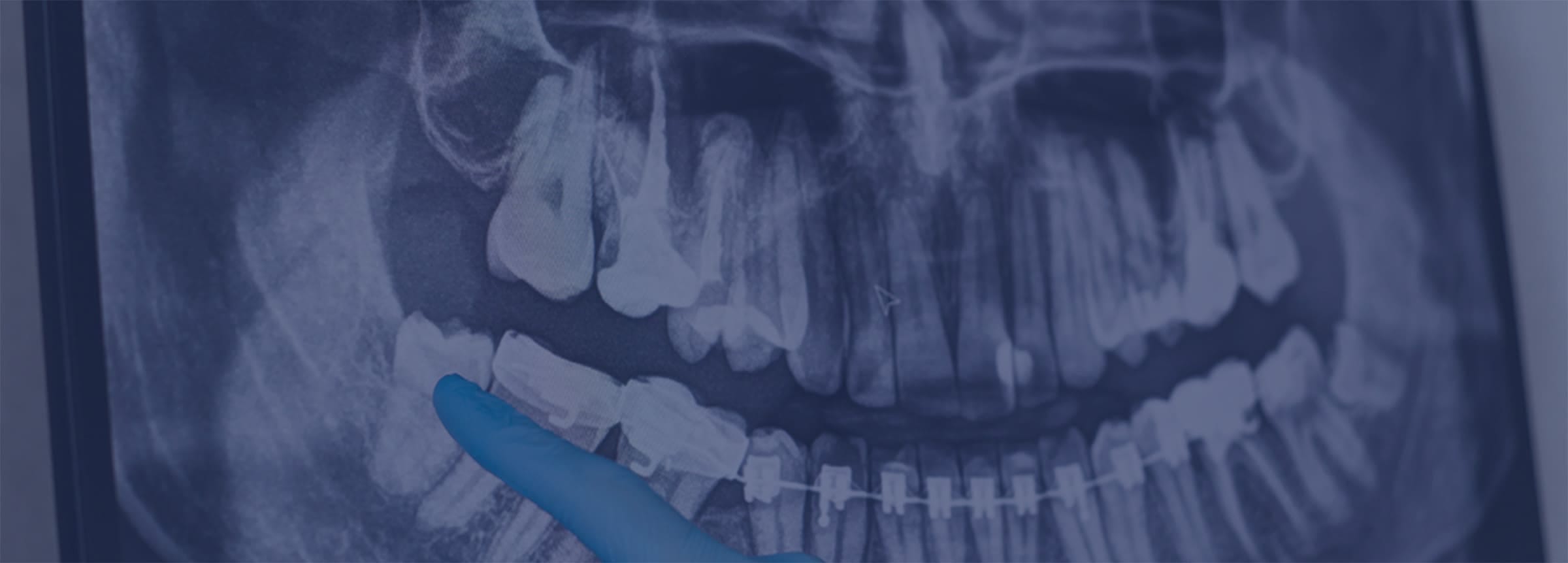 静脈内鎮静法で親知らずの抜歯を行った話