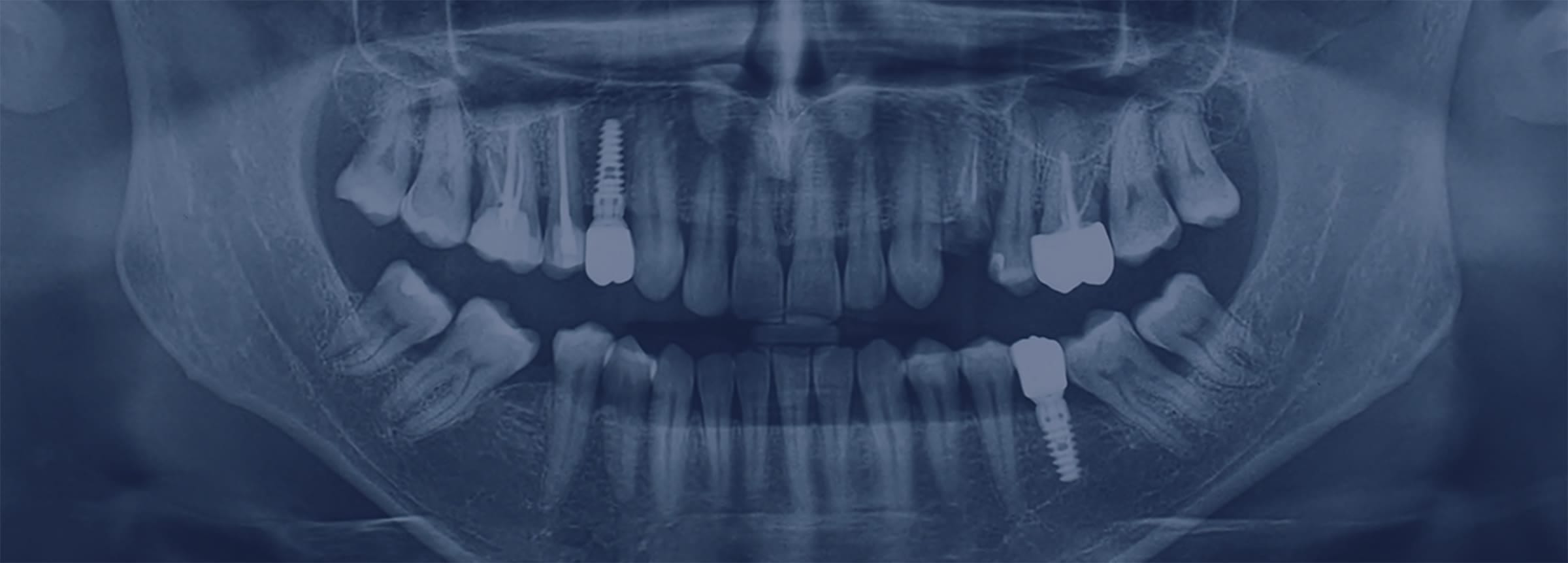 静脈内鎮静法でインプラント手術を行った話
