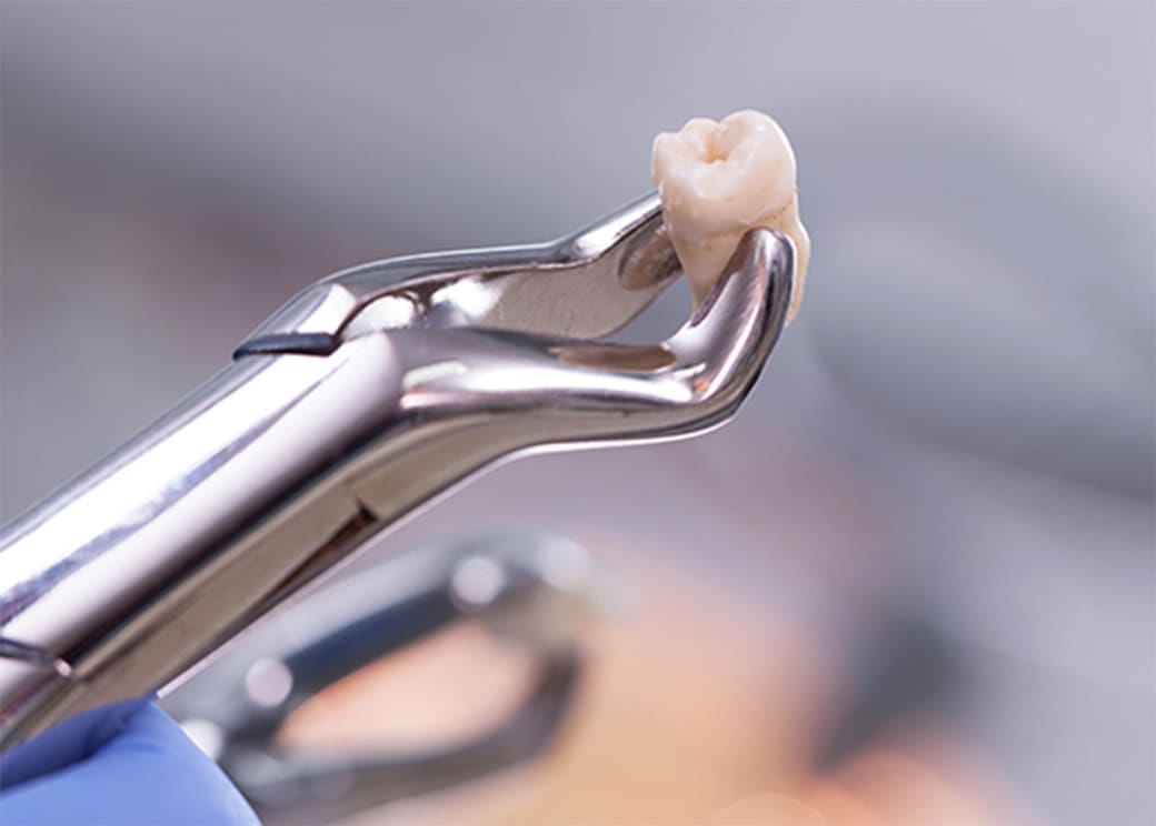 親知らずの抜歯に恐怖心。痛みなく抜きたい。